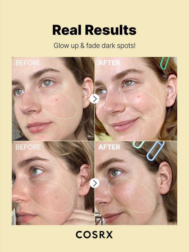COSRX Vitamin C 23 Serum – real results before and after pigmentation treatment