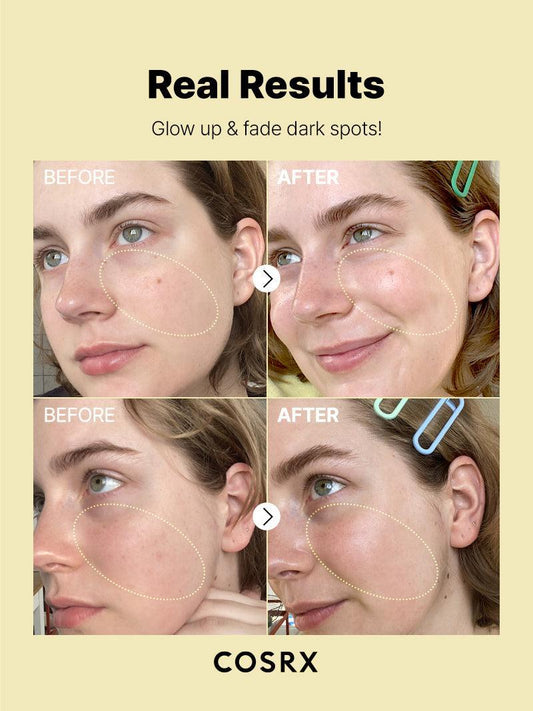 COSRX Vitamin C 23 Serum – real results before and after pigmentation treatment